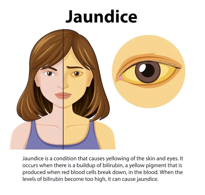 Jaundice